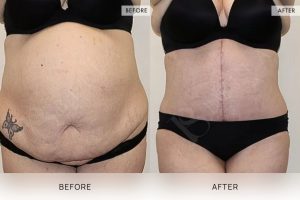 Open Book Tummy Tuck Patient 31 - 32