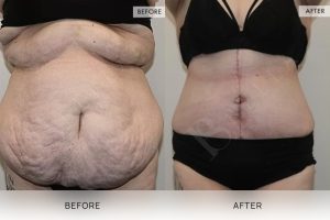 Open Book Tummy Tuck Patient 32 - 33