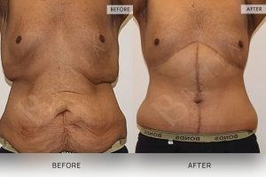 Open Book Tummy Tuck Patient 33 - 34