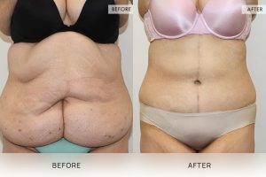 Open Book Tummy Tuck Patient 34 - 35