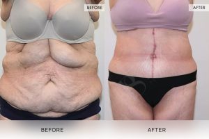 Open Book Tummy Tuck Patient 35 - 36