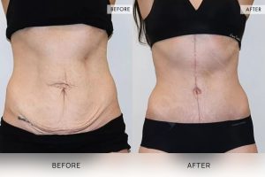 Open Book Tummy Tuck Patient 36 - 37