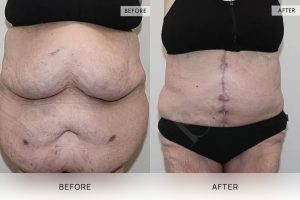 Open Book Tummy Tuck Patient 37 - 38