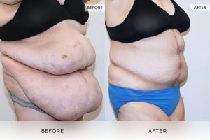 Open Book Tummy Tuck Patient 38 - 39