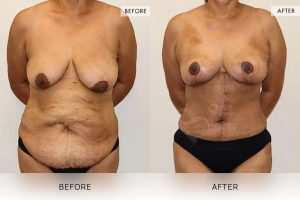 Open Book Tummy Tuck Patient 04 - 5