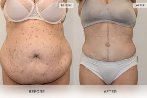 Open Book Tummy Tuck Patient 05 - 6