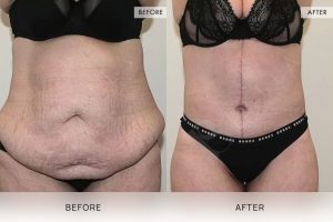 Open Book Tummy Tuck Patient 06 - 7