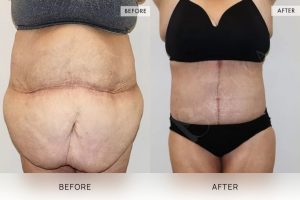 Open Book Tummy Tuck Patient 07 - 8