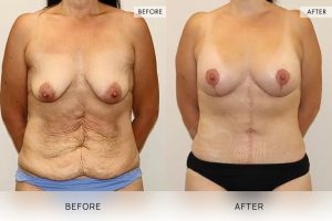 Open Book Tummy Tuck Patient 08 - 9
