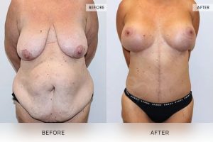 Open Book Tummy Tuck Patient 09 - 10