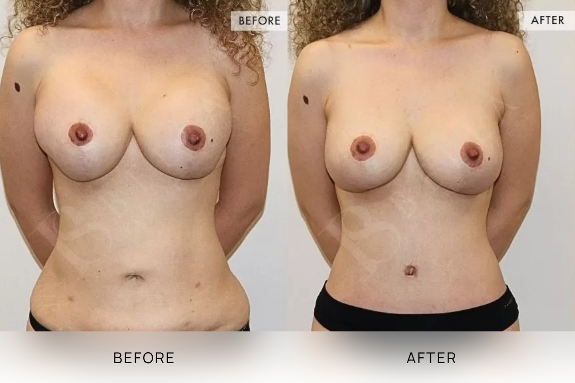 Surgical BA Images, Bella Plastic Surgery