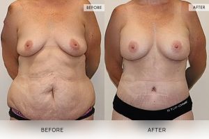Post-Pregnancy Surgery Patient 11 12 Post-Pregnancy Surgery Patient 11 - 12