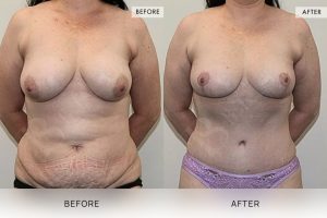Post-Pregnancy Surgery Patient 12 13 Post-Pregnancy Surgery Patient 12 - 13