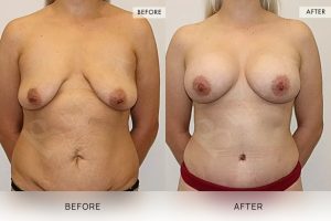 Post-Pregnancy Surgery Patient 13 14 Post-Pregnancy Surgery Patient 13 - 14