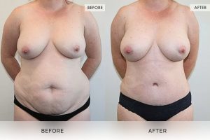 Post-Pregnancy Surgery Patient 14 15 Post-Pregnancy Surgery Patient 14 - 15