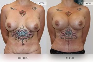 Post-Pregnancy Surgery Patient 15 16 Post-Pregnancy Surgery Patient 15 - 16