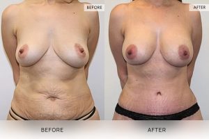 Post-Pregnancy Surgery Patient 16 17 Post-Pregnancy Surgery Patient 16 - 17