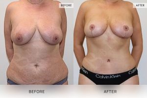 Post-Pregnancy Surgery Patient 17 18 Post-Pregnancy Surgery Patient 17 - 18