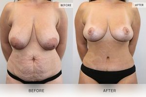 Post-Pregnancy Surgery Patient 18 19 Post-Pregnancy Surgery Patient 18 - 19