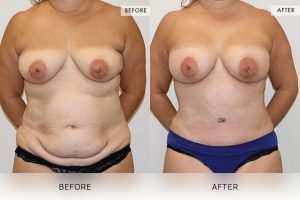 Post-Pregnancy Surgery Patient 19 20 Post-Pregnancy Surgery Patient 19 - 20