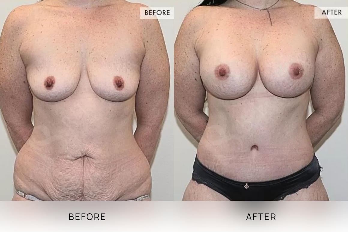 Surgical BA Images, Bella Plastic Surgery