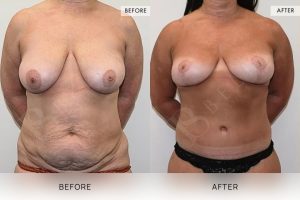 Post-Pregnancy Surgery Patient 21 22 Post-Pregnancy Surgery Patient 21 - 22