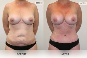 Post-Pregnancy Surgery Patient 03 4 Post-Pregnancy Surgery Patient 03 - 4