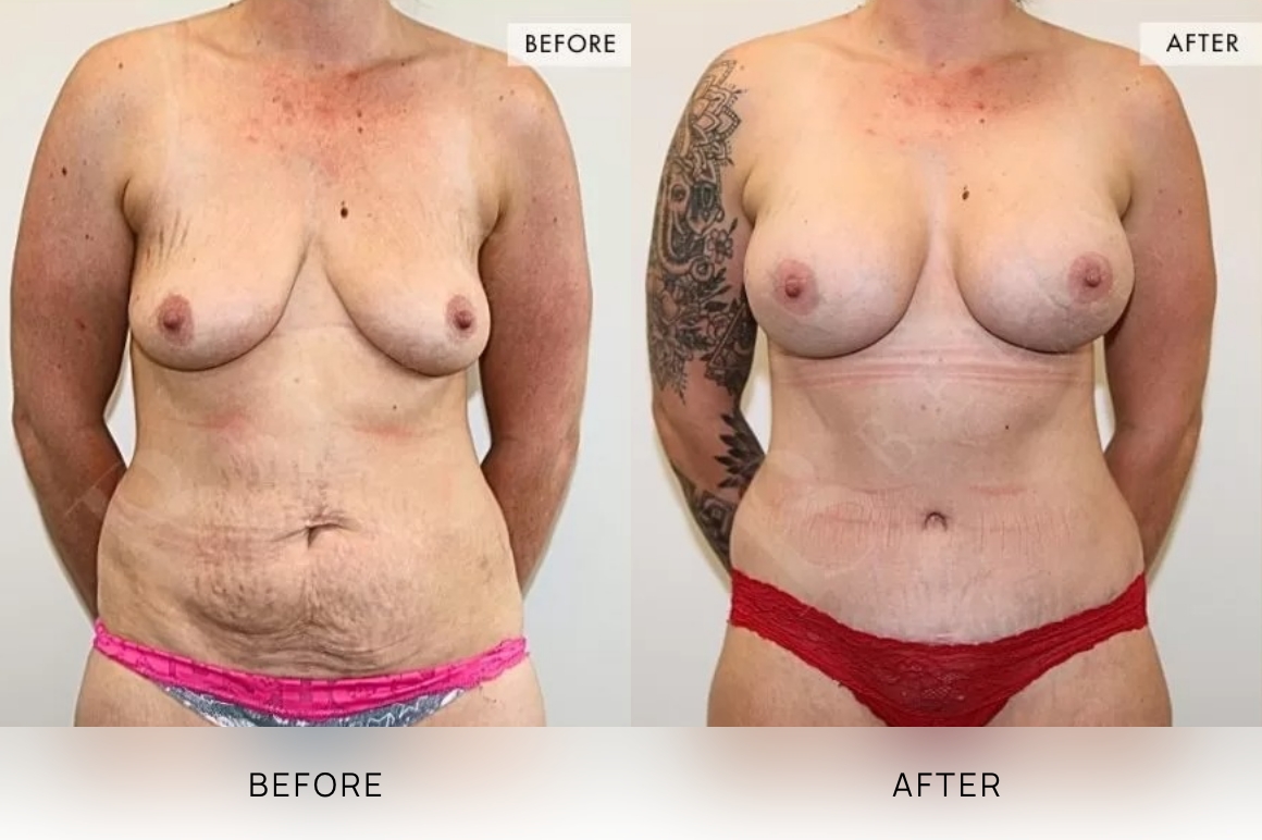 Surgical BA Images, Bella Plastic Surgery