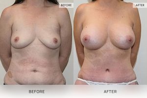 Post-Pregnancy Surgery Patient 06 7 Post-Pregnancy Surgery Patient 06 - 7