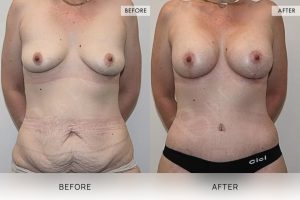 Post-Pregnancy Surgery Patient 07 8 Post-Pregnancy Surgery Patient 07 - 8
