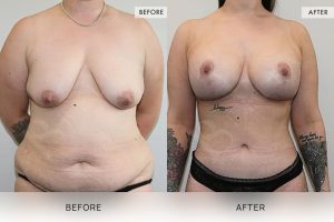 Post-Weight Loss Body Contouring Patient 01 2 Post-Weight Loss Body Contouring Patient 01 - 2