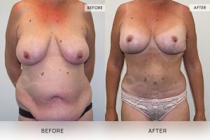 Post-Weight Loss Body Contouring Patient 10 11 Post-Weight Loss Body Contouring Patient 10 - 11