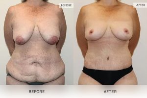 Post-Weight Loss Body Contouring Patient 02 3 Post-Weight Loss Body Contouring Patient 02 - 3