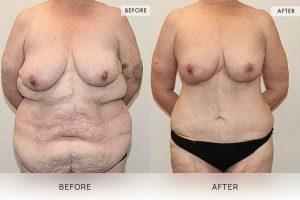 Post-Weight Loss Body Contouring Patient 03 4 Post-Weight Loss Body Contouring Patient 03 - 4