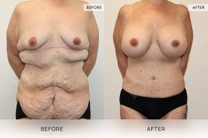 Post-Weight Loss Body Contouring Patient 04 5 Post-Weight Loss Body Contouring Patient 04 - 5