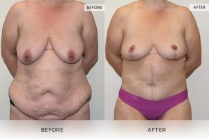 Post-Weight Loss Body Contouring Patient 05 6 Post-Weight Loss Body Contouring Patient 05 - 6