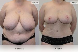 Post-Weight Loss Body Contouring Patient 06 7 Post-Weight Loss Body Contouring Patient 06 - 7