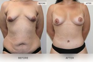 Post-Weight Loss Body Contouring Patient 07 8 Post-Weight Loss Body Contouring Patient 07 - 8