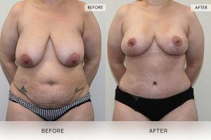 Post-Weight Loss Body Contouring Patient 08 9 Post-Weight Loss Body Contouring Patient 08 - 9