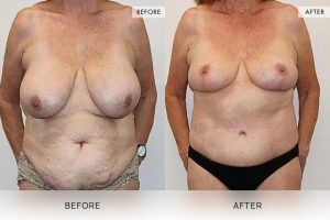 Post-Weight Loss Body Contouring Patient 09 10 Post-Weight Loss Body Contouring Patient 09 - 10