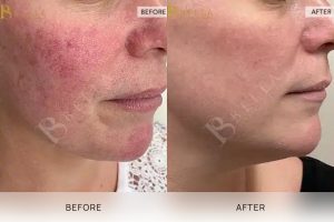 Skin treatments before anf after gallery 1