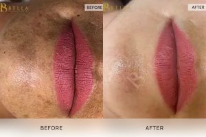 Skin Treatment 03 - 2