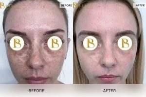 Skin Treatment 05 - 4