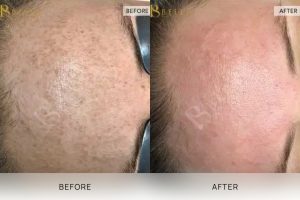 Skin Treatment 06 - 5