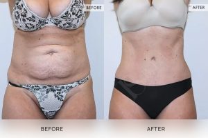 Tummy Tuck Patient 01 - 2