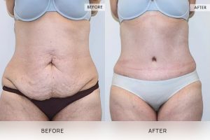 Tummy Tuck Patient 10 - 11