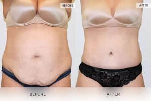 Tummy Tuck Patient 11 - 12