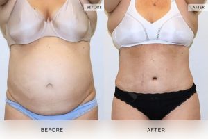 Tummy Tuck Patient 12 - 13