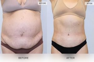 Tummy Tuck Patient 13 - 14