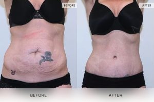 Tummy Tuck Patient 14 - 15